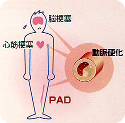 末梢動脈疾患（PAD）